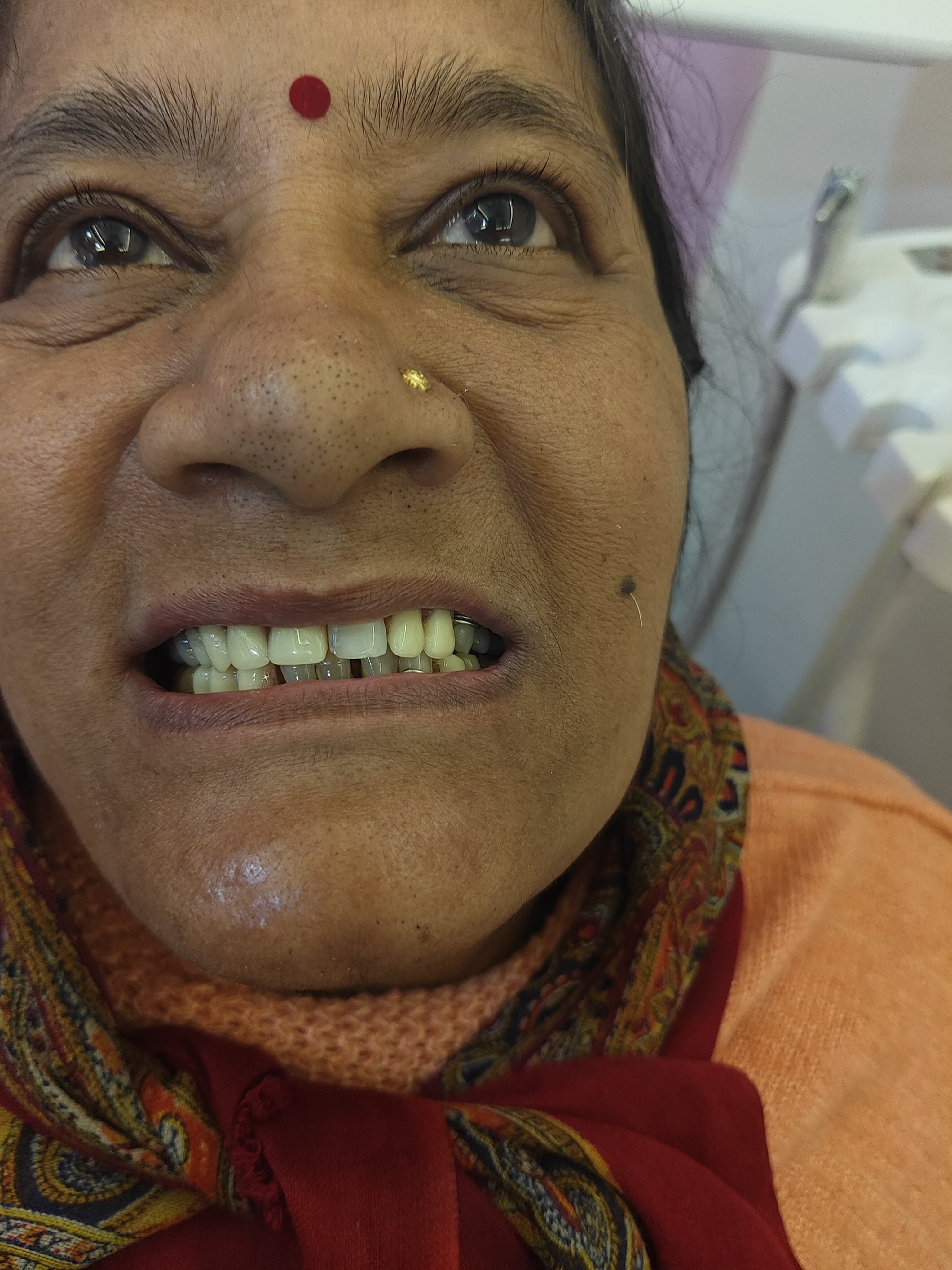 Smile Transformation Case 9
